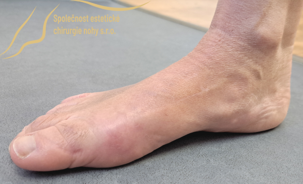 right bunion post-operative photo